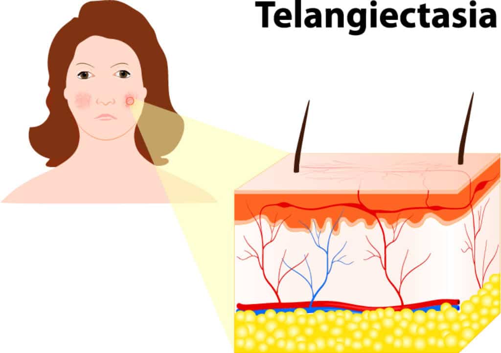 Veinwave™ Knoxville TN