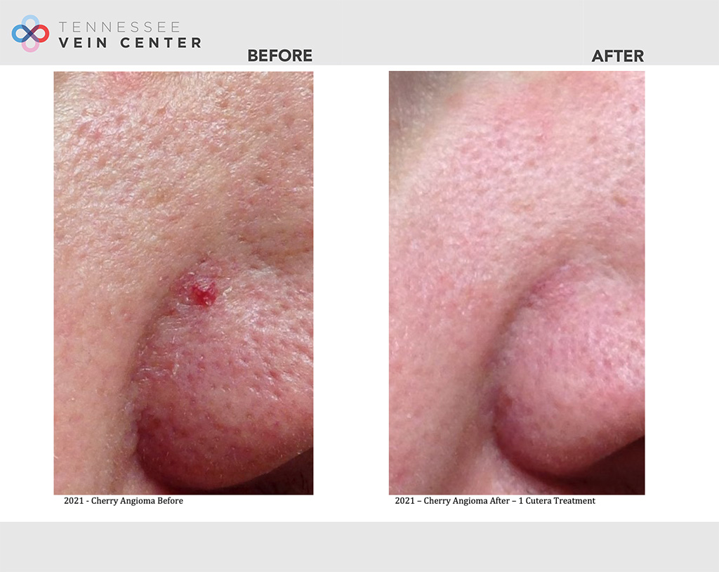 Before and After Image: Veins 1038 - right-front-oblique