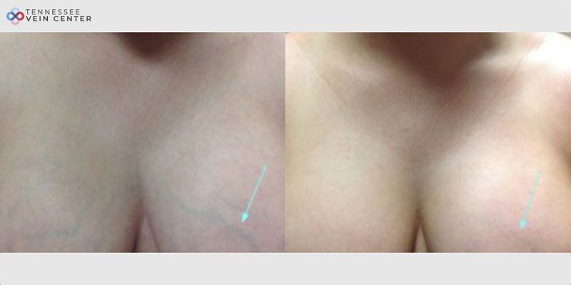Before and After Image: Chest Veins 1142 - front