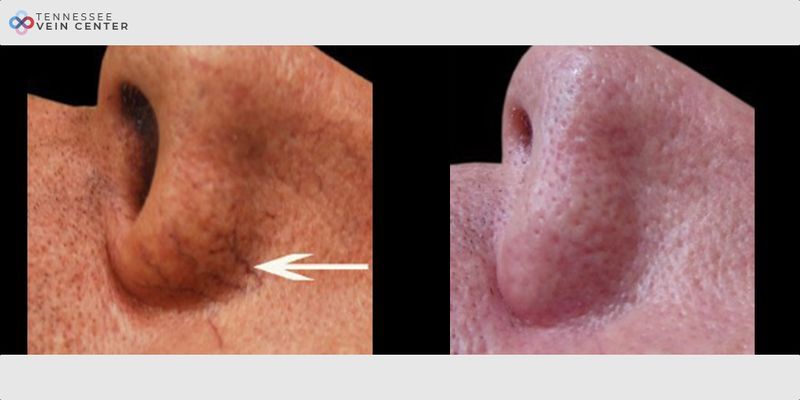 Before and After Image: Face Veins 1006 - front