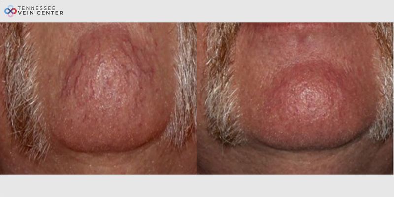 Before and After Image: Face Veins 1143 - front