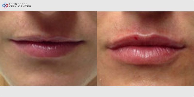 Before and After Image: Lip Filler 1476 - front