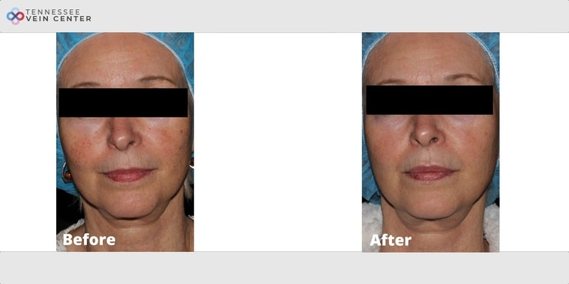 Before and After Image: Lumecca 2722 - front