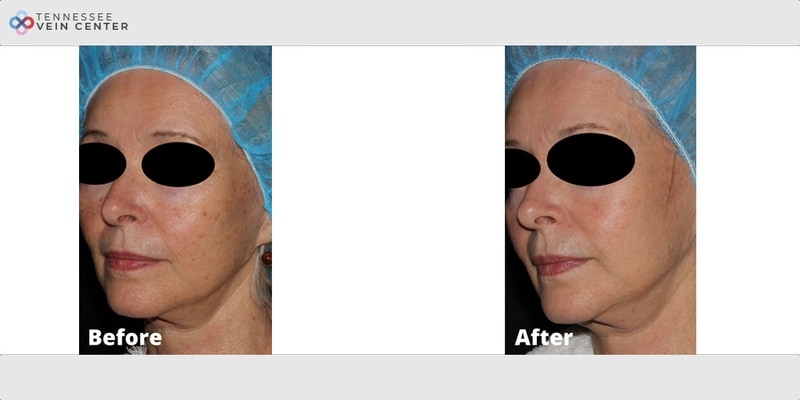 Before and After Image: Lumecca 2722 - left-front-oblique