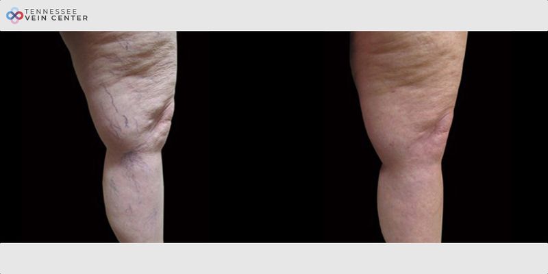 Before and After Image: Spider Veins 1009 - right-side
