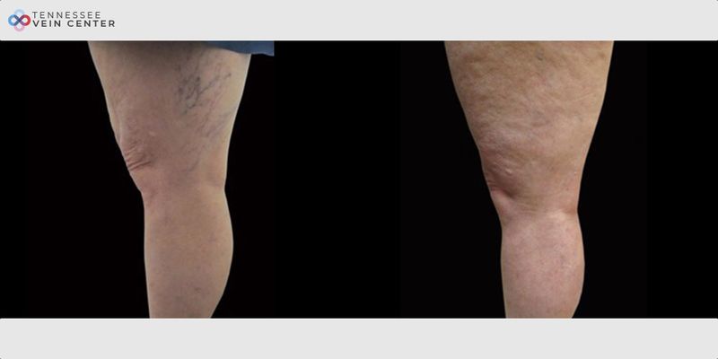 Before and After Image: Spider Veins 1010 - left-side