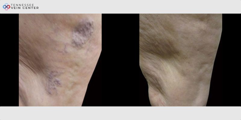 Before and After Image: Spider Veins 1011 - left-side