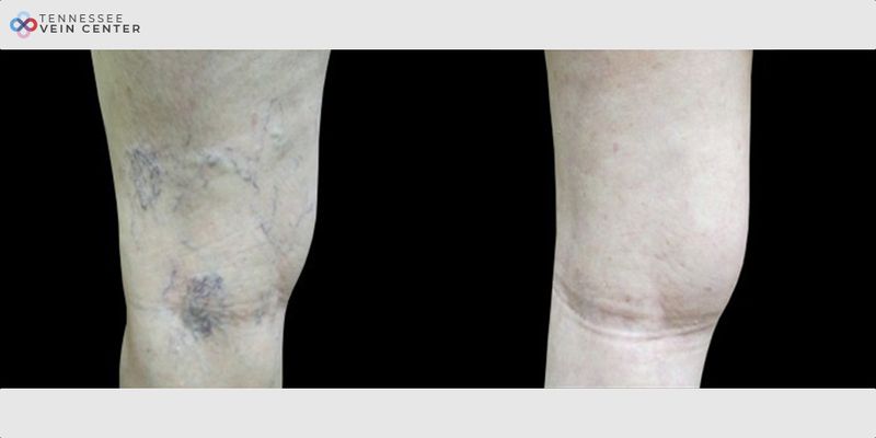 Before and After Image: Spider Veins 1012 - back