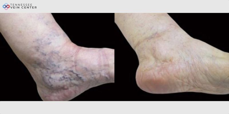 Before and After Image: Spider Veins 1013 - right-side