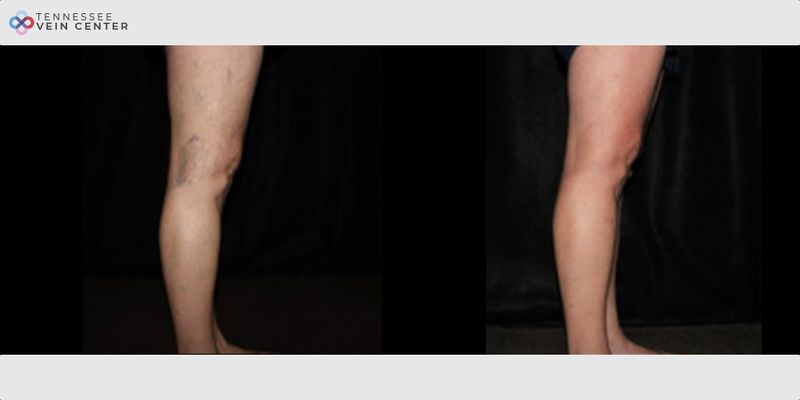 Before and After Image: Spider Veins 1142 - right-side