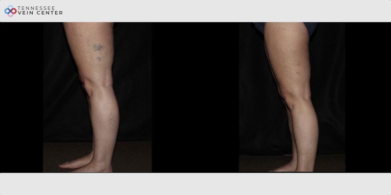Before and After Image: Spider Veins 1146 - left-side