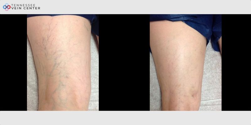 Before and After Image: Spider Veins 1488 - front