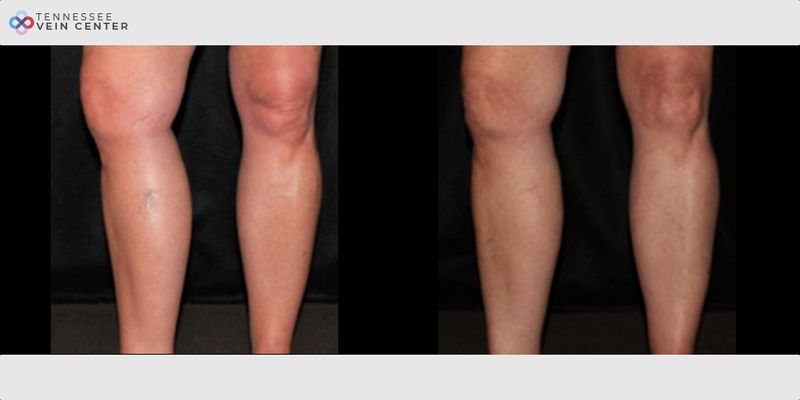 Before and After Image: Spider Veins 1494 - front