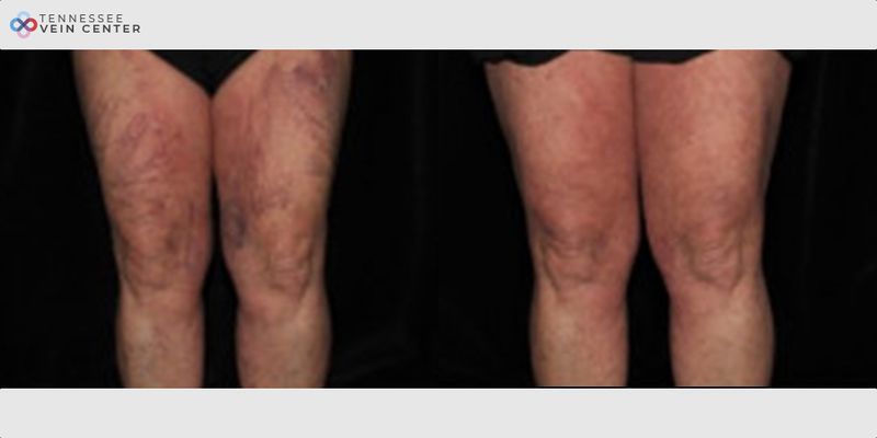 Before and After Image: Spider Veins 1504 - front