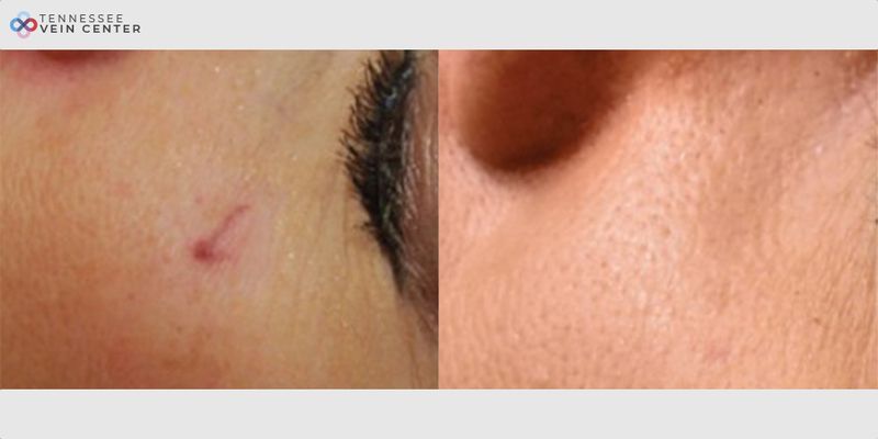 Before and After Image: Scars 1003 - left-side