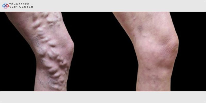 Before and After Image: Varicose Veins 1027 - right-side