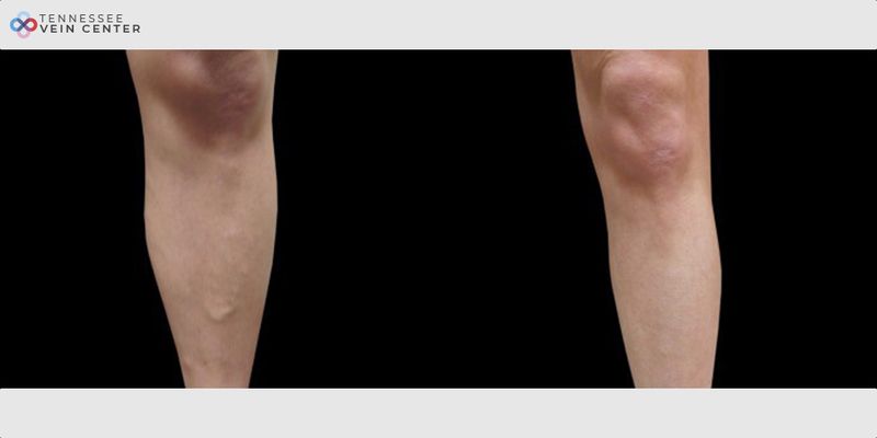 Before and After Image: Varicose Veins 1028 - front