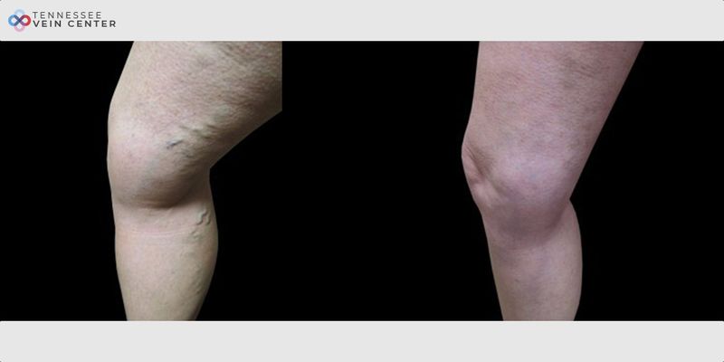 Before and After Image: Varicose Veins 1030 - left-side