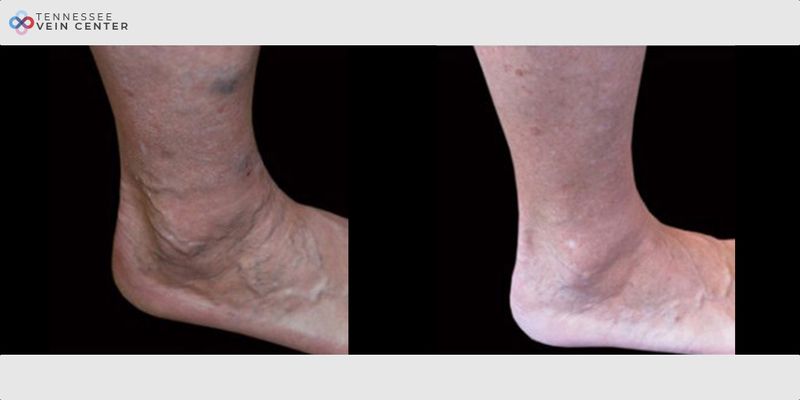 Before and After Image: Varicose Veins 1031 - right-side