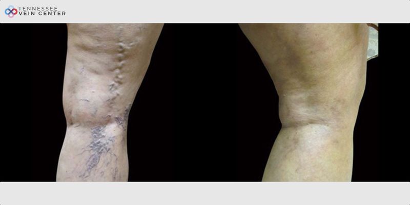 Before and After Image: Varicose Veins 1032 - back
