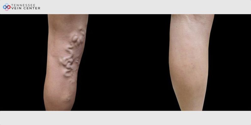 Before and After Image: Varicose Veins 1034 - right-back-oblique