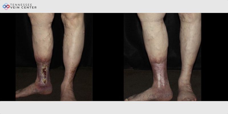 Before and After Image: Varicose Veins 1038 - back