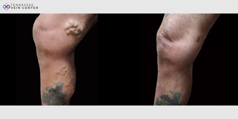 Before and After Image: Varicose Veins 1056 - left-side