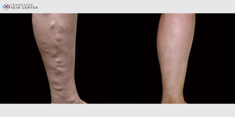 Before and After Image: Varicose Veins 1057 - right-side