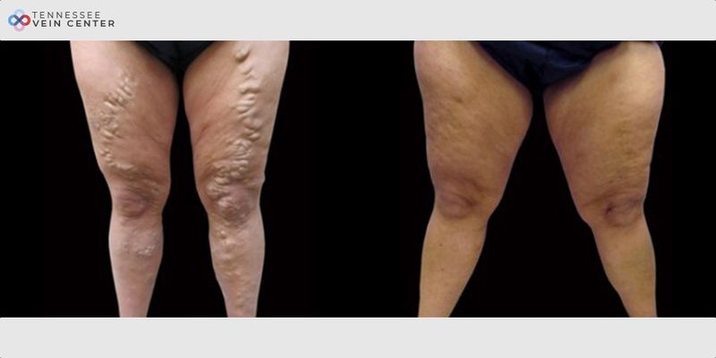 Before and After Image: Varicose Veins 1058 - front