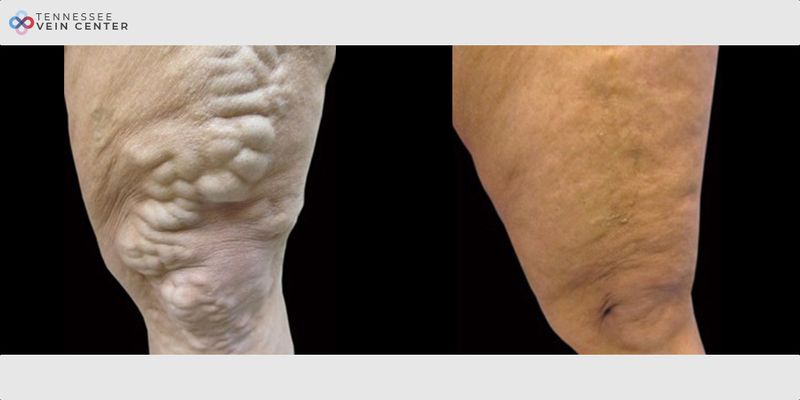 Before and After Image: Varicose Veins 1059 - left-side