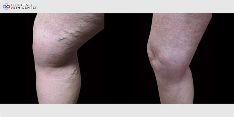 Before and After Image: Varicose Veins 1062 - left-side
