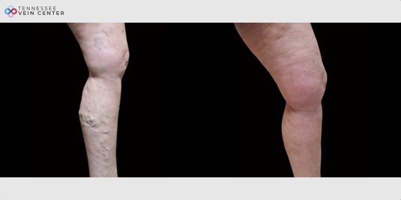 Before and After Image: Varicose Veins 1080 - right-side