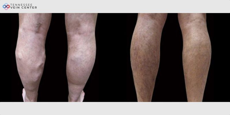 Before and After Image: Varicose Veins 1085 - back