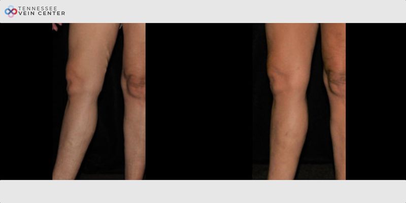 Before and After Image: Varicose Veins 1491 - front