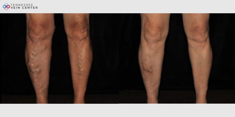 Before and After Image: Varicose Veins 1499 - front