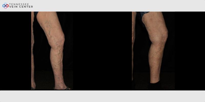 Before and After Image: Varicose Veins 1516 - right-front-oblique