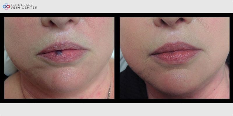 Before and After Image: Venous Lake 0930 - front