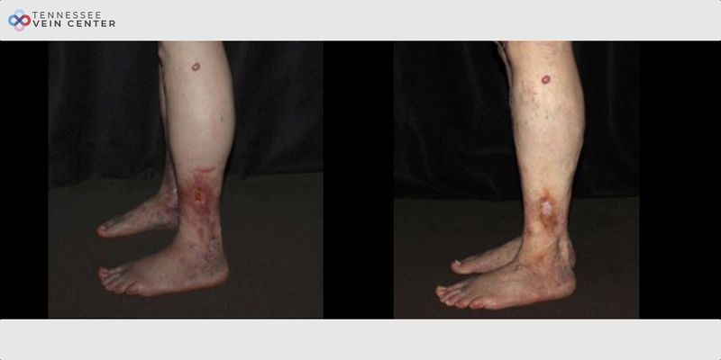 Before and After Image: Venous Ulcer 1242 - left-side