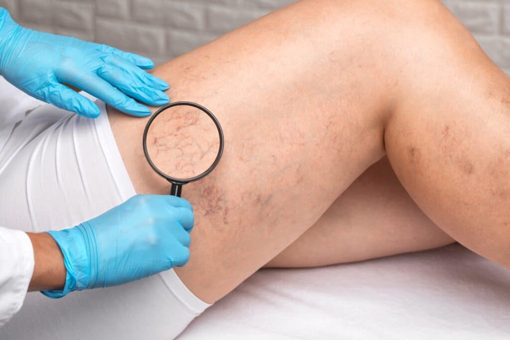 Close up of a doctor examining the varicose veins on a patient's legs in preparation for endovenous thermal ablation