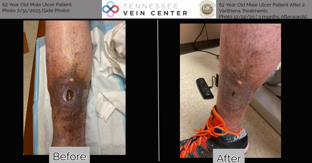 Before and After Image: Venous Ulcer - front