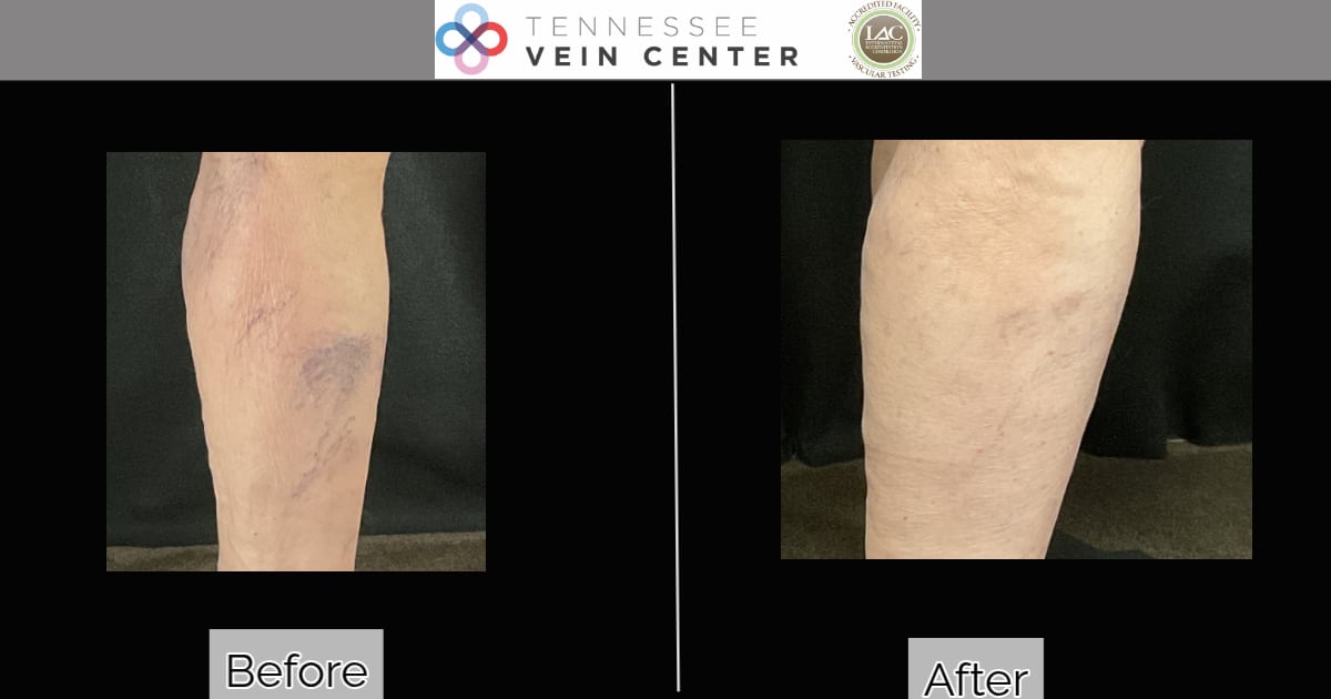 Before and After Image: Spider Veins 1525 - back