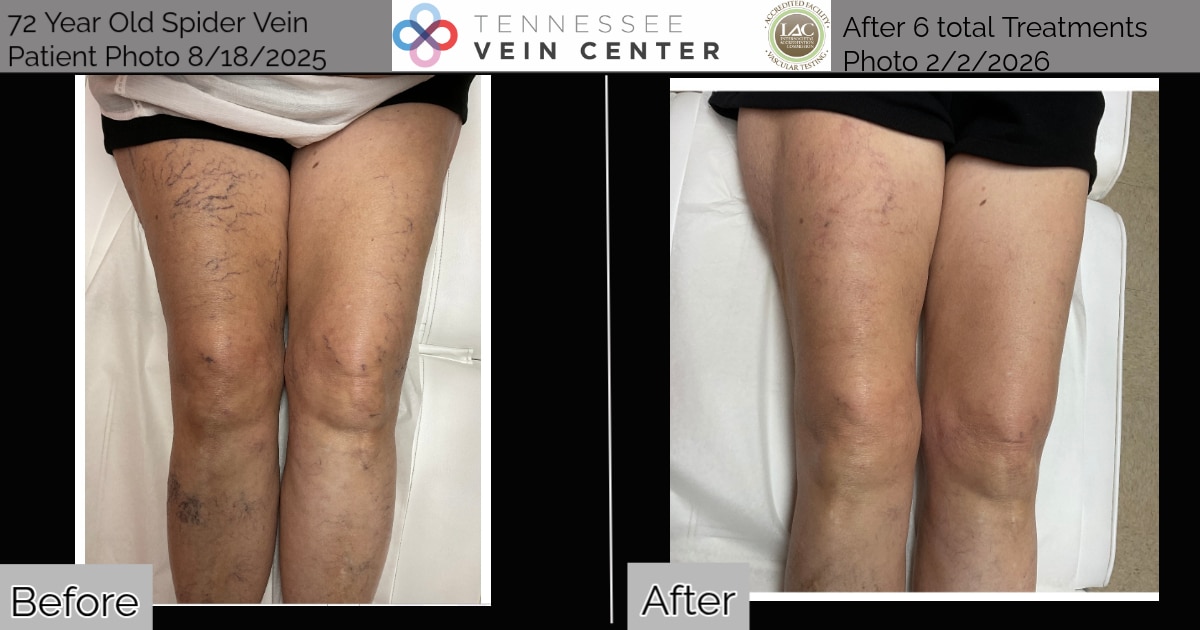 Before and After Image: Spider Veins 1530 - front