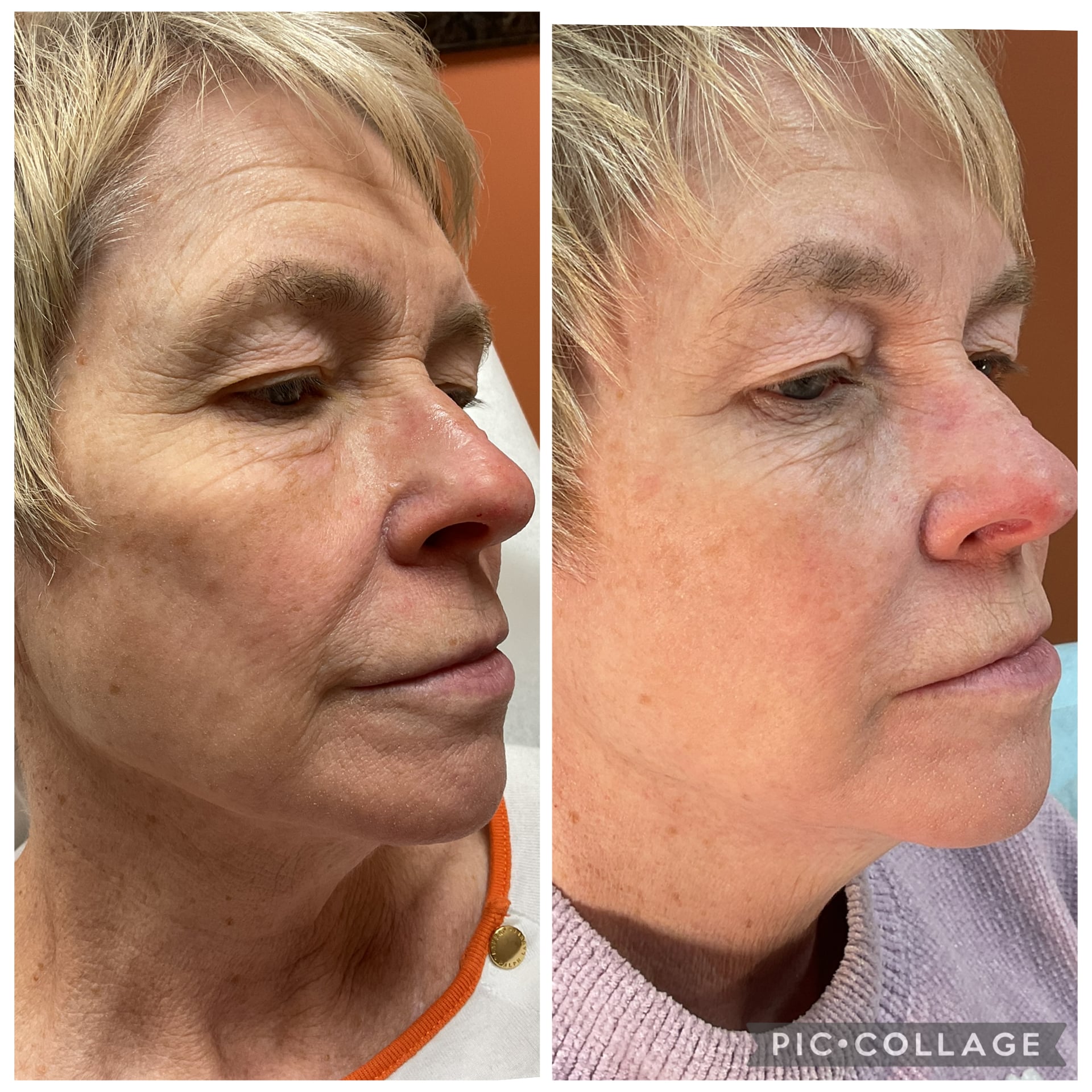 Skinvive before and after Skinvive