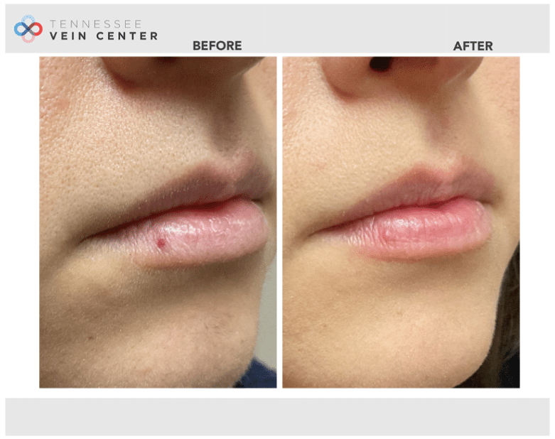 Before and After Image: Cherry Angioma on the lip - front