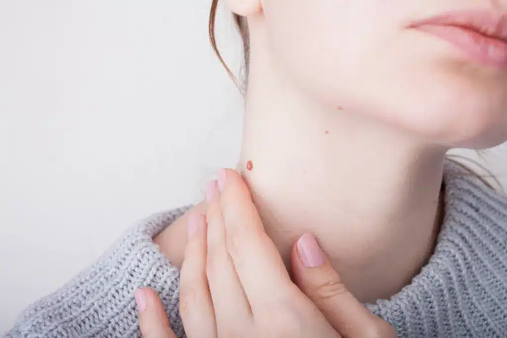 Warts Treatment in Alcoa, TN
