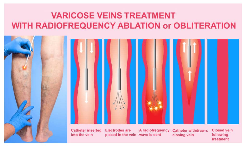 Endovenous Thermal Ablation Maryville TN