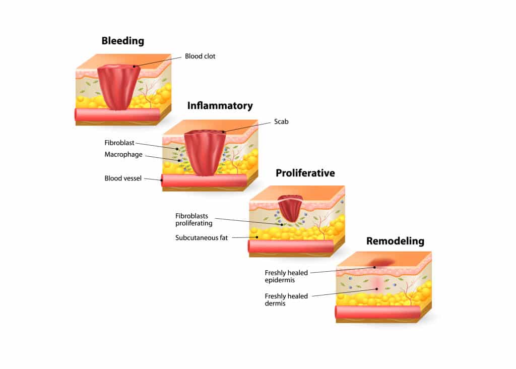 Fractora™ in Alcoa, TN
