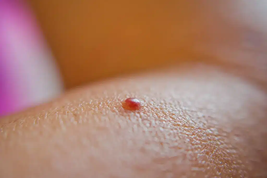 Cherry Angioma Removal Alcoa TN