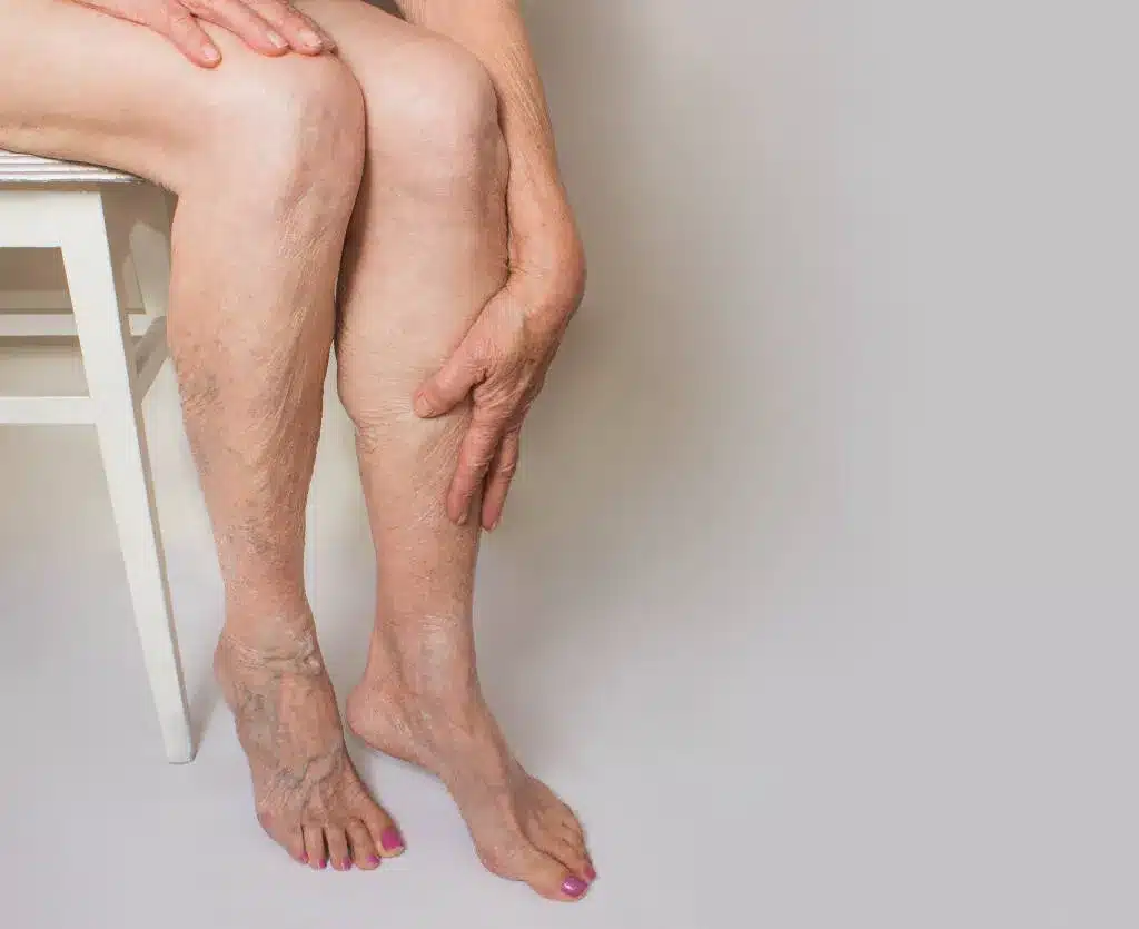 Leg Ulcers Treatment Knoxville TN