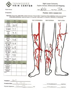 Varicose Vein Treatment Maryville TN